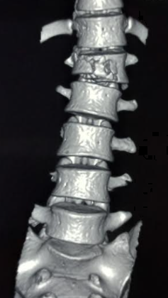 Vertebral compression fracture