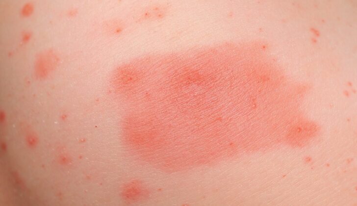 Chronic Urticaria (Chronic Hives)
