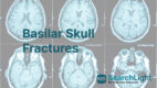 Basilar Skull Fractures