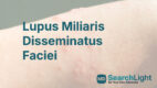 Lupus Miliaris Disseminatus Faciei