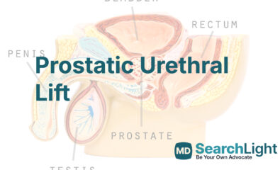 Prostatic Urethral Lift
