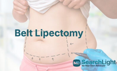 Belt Lipectomy