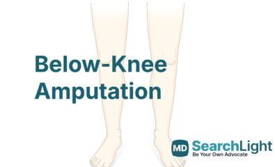 Below-Knee Amputation
