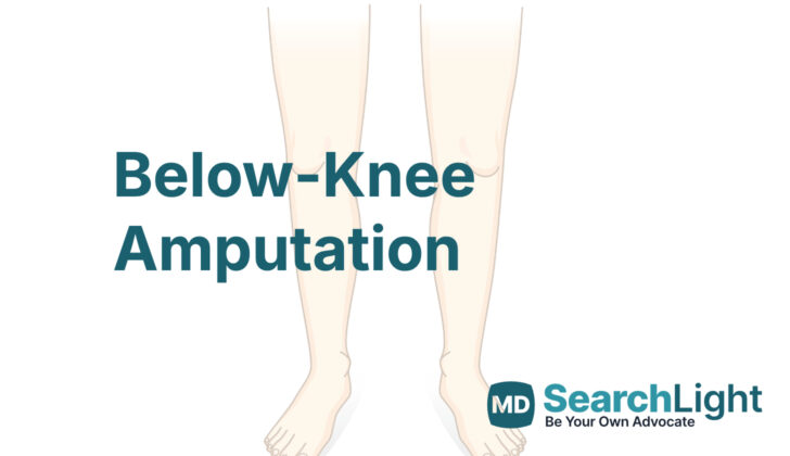 Below-Knee Amputation