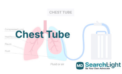 Chest Tube