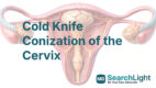 Cold Knife Conization of the Cervix