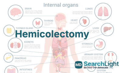 Hemicolectomy