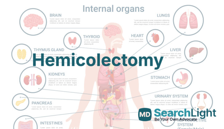 Hemicolectomy