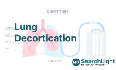 Lung Decortication