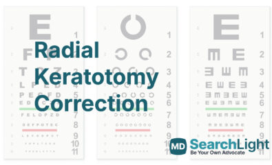 Radial Keratotomy Correction