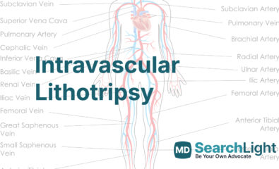 Intravascular Lithotripsy
