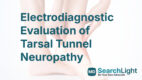 Electrodiagnostic Evaluation of Tarsal Tunnel Neuropathy