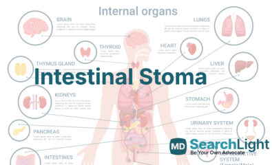 Intestinal Stoma