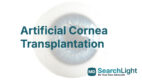 Artificial Cornea Transplantation