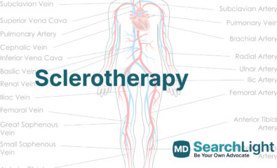 Sclerotherapy