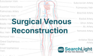 Surgical Venous Reconstruction