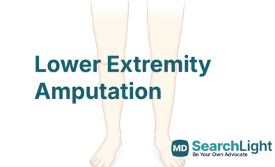 Lower Extremity Amputation