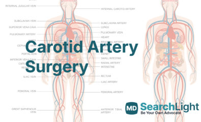 Carotid Artery Surgery