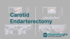 Carotid Endarterectomy