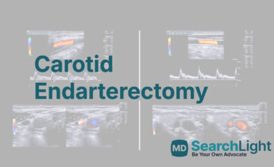 Carotid Endarterectomy