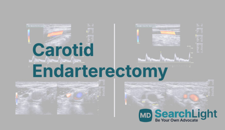 Carotid Endarterectomy