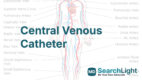 Central Venous Catheter