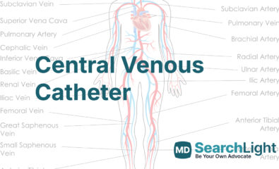 Central Venous Catheter