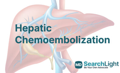 Hepatic Chemoembolization