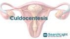 Culdocentesis
