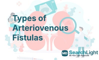 Types of Arteriovenous Fistulas