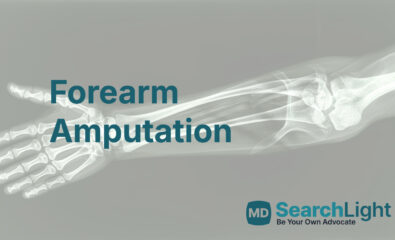 Forearm Amputation