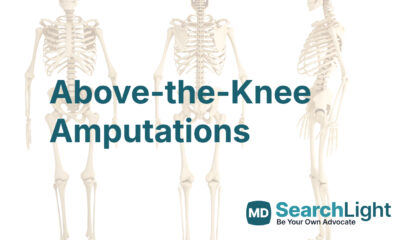 Above-the-Knee Amputations