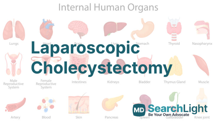 Laparoscopic Cholecystectomy