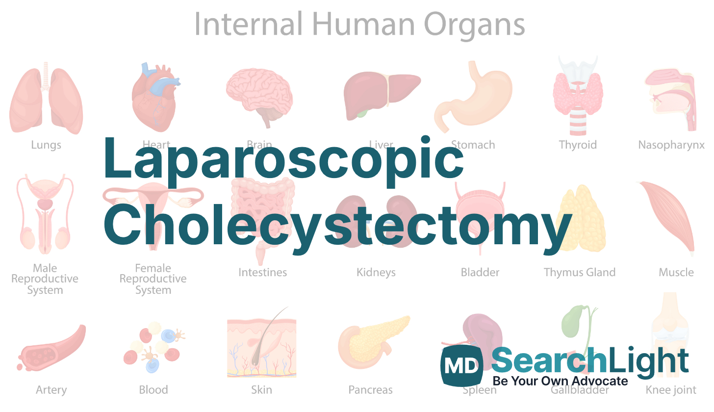 Laparoscopic Cholecystectomy (Cholecystectomy) - MD Searchlight Laparoscopic Cholecystectomy (Cholecystectomy) - MD Searchlight