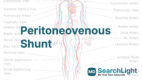 Peritoneovenous Shunt