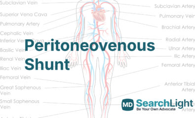 Peritoneovenous Shunt