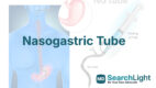Nasogastric Tube