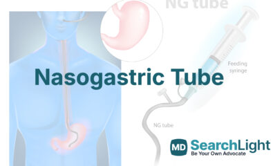 Nasogastric Tube