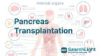 Pancreas Transplantation