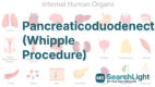 Pancreaticoduodenectomy (Whipple Procedure)