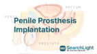 Penile Prosthesis Implantation