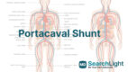 Portacaval Shunt