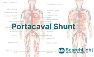 Portacaval Shunt