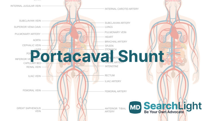 Portacaval Shunt