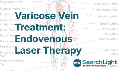 Varicose Vein Treatment: Endovenous Laser Therapy
