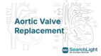 Aortic Valve Replacement