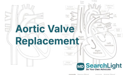 Aortic Valve Replacement
