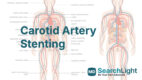 Carotid Artery Stenting
