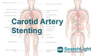 Carotid Artery Stenting