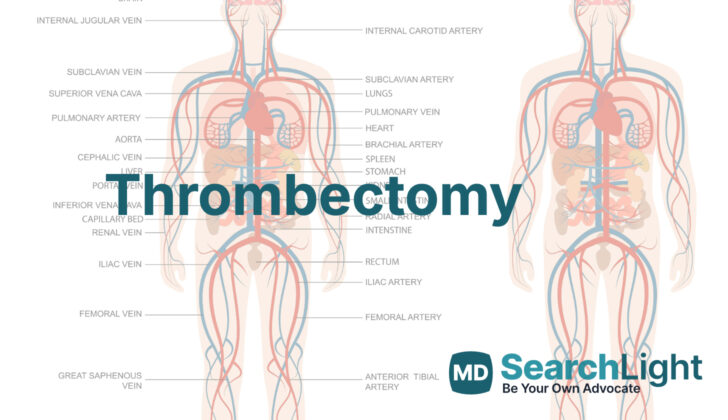 Thrombectomy